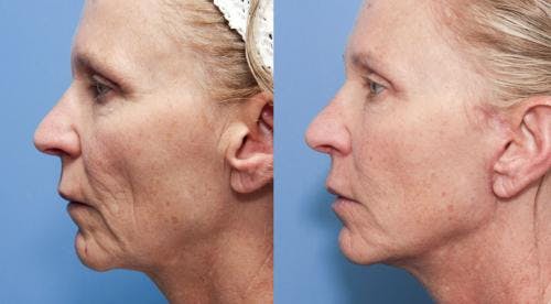 Face Lift Before & After Gallery - Patient 58213240 - Image 2