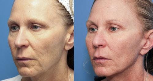 Face Lift Before & After Gallery - Patient 58213240 - Image 3