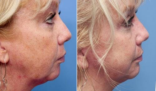 Face Lift Before & After Gallery - Patient 58213241 - Image 1