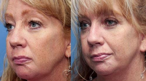 Face Lift Before & After Gallery - Patient 58213241 - Image 3