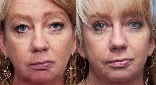 Face Lift Before & After Gallery - Patient 58213241 - Image 1