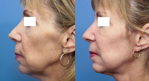 Face Lift Before & After Gallery - Patient 58213242 - Image 1