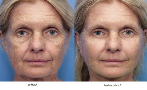Face Lift Before & After Gallery - Patient 58213243 - Image 1