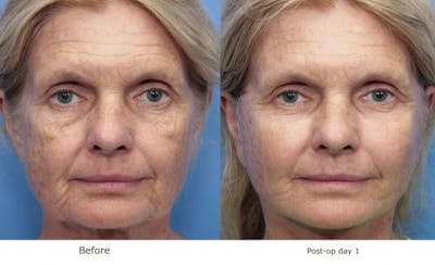 Face Lift Before & After Gallery - Patient 58213243 - Image 1