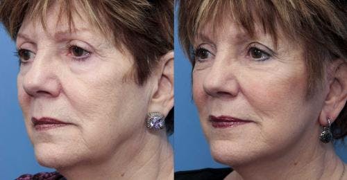 Face Lift Before & After Gallery - Patient 58213244 - Image 1