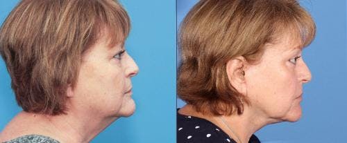 Neck Lift Before & After Gallery - Patient 58213277 - Image 1