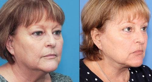 Neck Lift Before & After Gallery - Patient 58213277 - Image 2