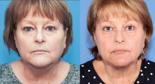 Neck Lift Before & After Gallery - Patient 58213277 - Image 3