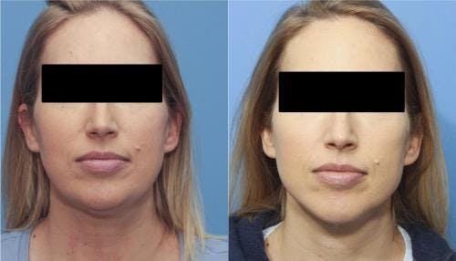 Neck Lift Before & After Gallery - Patient 58213278 - Image 4