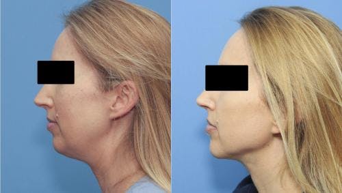 Neck Lift Before & After Gallery - Patient 58213278 - Image 1