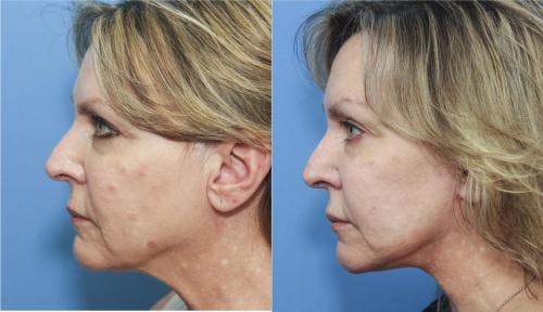 Neck Lift Before & After Gallery - Patient 58213279 - Image 1