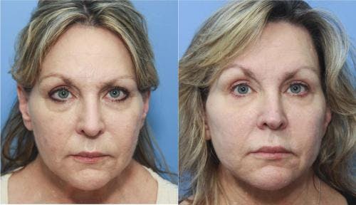 Neck Lift Before & After Gallery - Patient 58213279 - Image 2