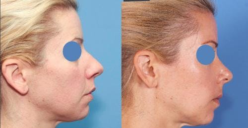 Rhinoplasty Before & After Gallery - Patient 58213280 - Image 1