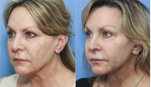 Neck Lift Before & After Gallery - Patient 58213279 - Image 3
