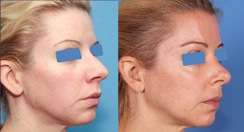 Rhinoplasty Before & After Gallery - Patient 58213280 - Image 2