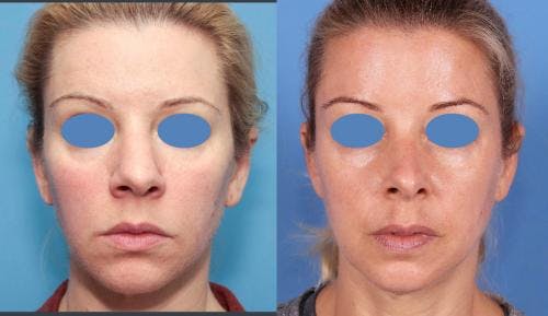 Rhinoplasty Before & After Gallery - Patient 58213280 - Image 3