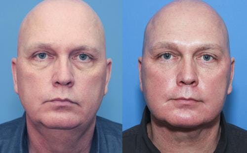 Neck Lift Before & After Gallery - Patient 58213281 - Image 2