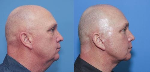 Neck Lift Before & After Gallery - Patient 58213281 - Image 1