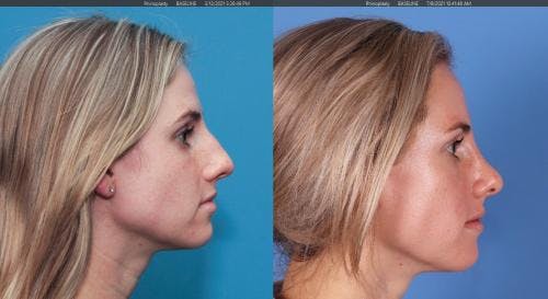 Rhinoplasty Before & After Gallery - Patient 58213282 - Image 1