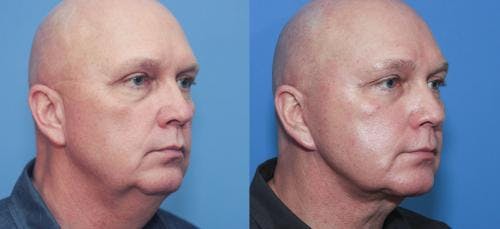 Neck Lift Before & After Gallery - Patient 58213281 - Image 3