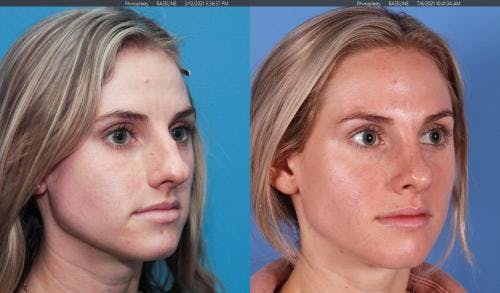 Rhinoplasty Before & After Gallery - Patient 58213282 - Image 2