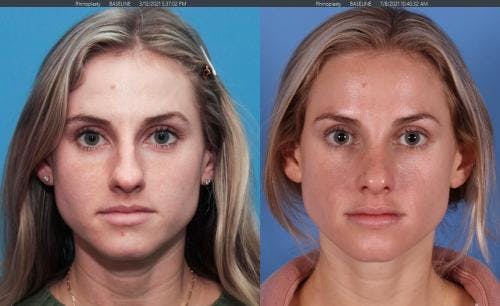 Rhinoplasty Before & After Gallery - Patient 58213282 - Image 3