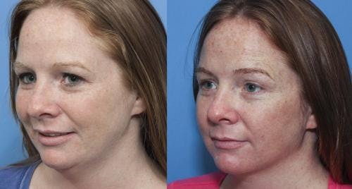Neck Lift Before & After Gallery - Patient 58213283 - Image 2