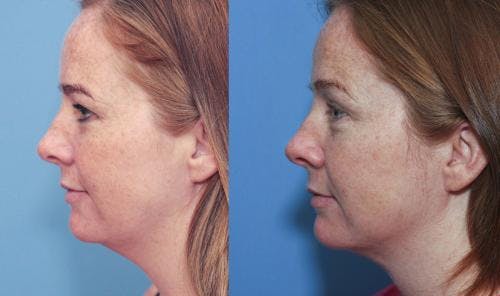Neck Lift Before & After Gallery - Patient 58213283 - Image 1