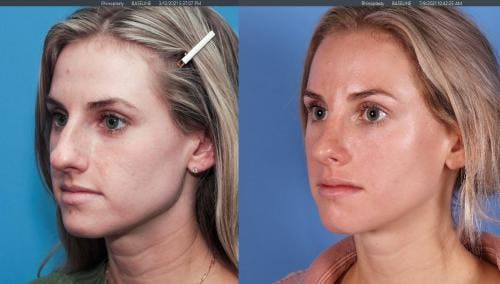 Rhinoplasty Before & After Gallery - Patient 58213282 - Image 4