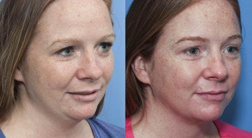 Neck Lift Before & After Gallery - Patient 58213283 - Image 3