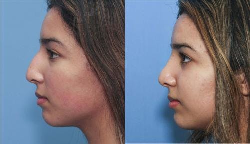 Rhinoplasty Before & After Gallery - Patient 58213284 - Image 1