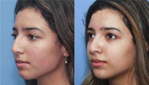 Rhinoplasty Before & After Gallery - Patient 58213284 - Image 2