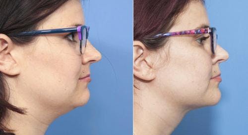 Neck Lift Before & After Gallery - Patient 58213285 - Image 2