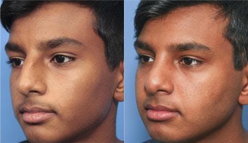 Rhinoplasty Before & After Gallery - Patient 58213286 - Image 1