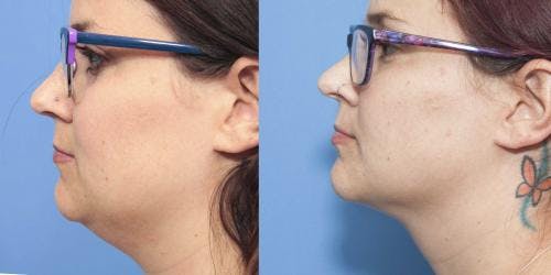 Neck Lift Before & After Gallery - Patient 58213285 - Image 1