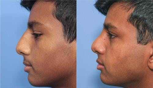 Rhinoplasty Before & After Gallery - Patient 58213286 - Image 2