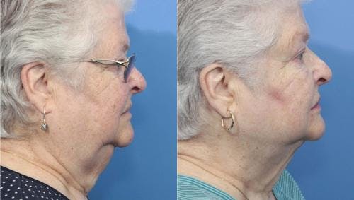 Neck Lift Before & After Gallery - Patient 58213287 - Image 4