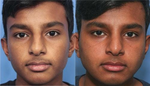 Rhinoplasty Before & After Gallery - Patient 58213286 - Image 3