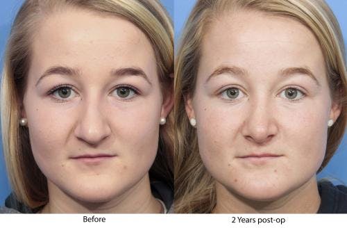 Rhinoplasty Before & After Gallery - Patient 58213288 - Image 2