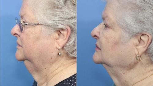 Neck Lift Before & After Gallery - Patient 58213287 - Image 1