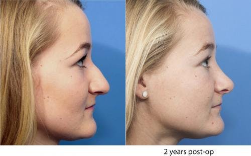 Rhinoplasty Before & After Gallery - Patient 58213288 - Image 1