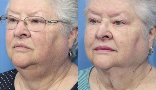 Neck Lift Before & After Gallery - Patient 58213287 - Image 6