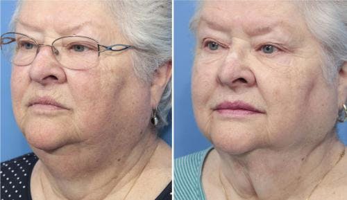 Neck Lift Before & After Gallery - Patient 58213287 - Image 2