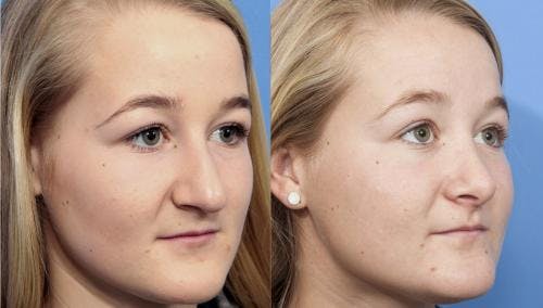 Rhinoplasty Before & After Gallery - Patient 58213288 - Image 3