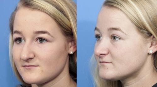 Rhinoplasty Before & After Gallery - Patient 58213288 - Image 4