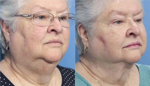 Neck Lift Before & After Gallery - Patient 58213287 - Image 5