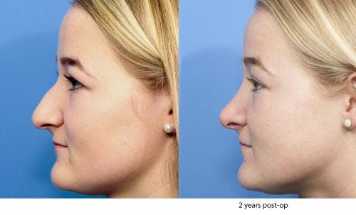 Rhinoplasty Before & After Gallery - Patient 58213288 - Image 5