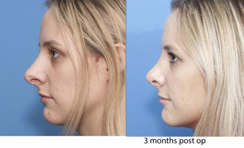 Rhinoplasty Before & After Gallery - Patient 58213289 - Image 1
