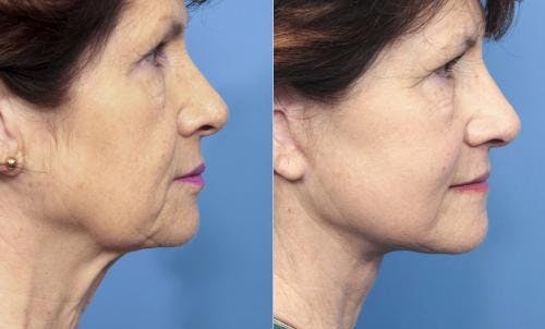 Neck Lift Before & After Gallery - Patient 58213291 - Image 5