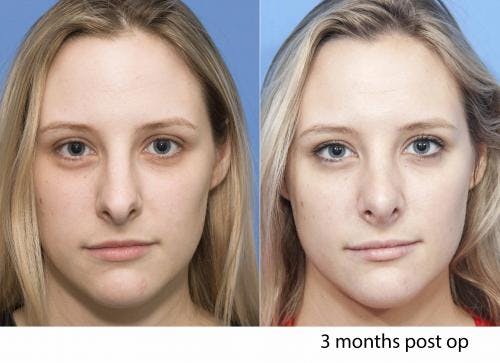 Rhinoplasty Before & After Gallery - Patient 58213289 - Image 2